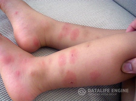 постельный клоп укусы